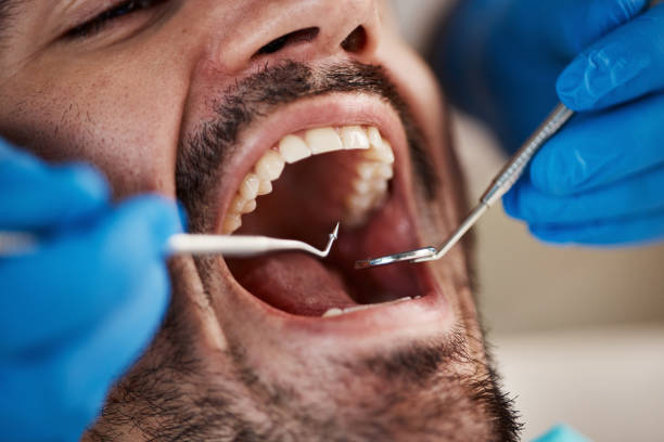 Best Knocked-Out Tooth (Avulsed Tooth) Treatment in West Park, CA